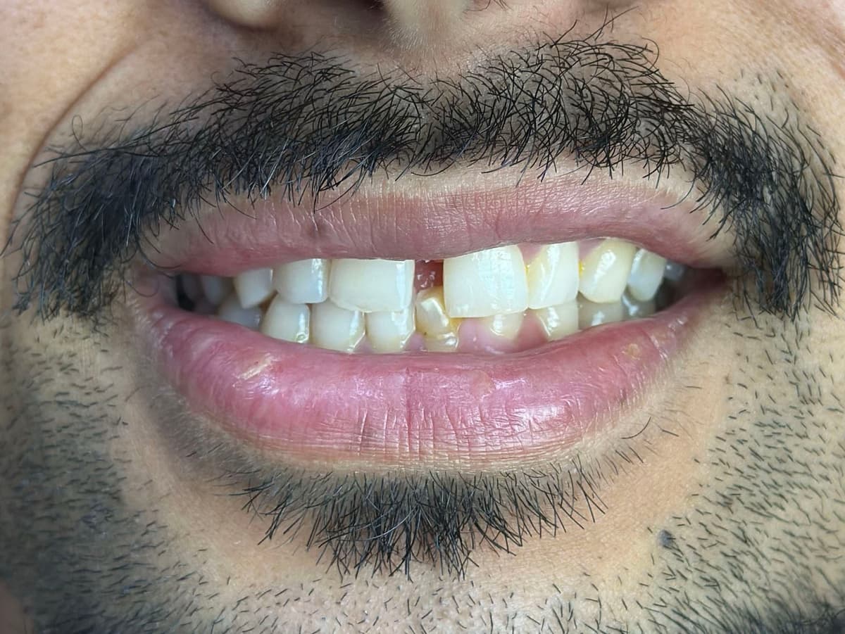 Before Emax Veneers