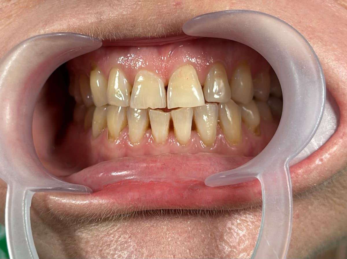 Before Emax Veneers